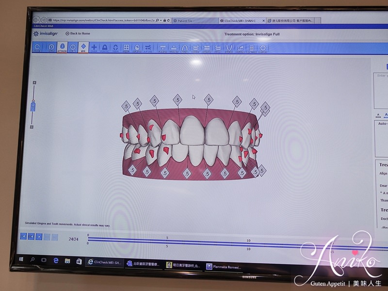 【保養】隱適美 Invisalign。矯正牙齒也能這麼低調！1個月心得分享