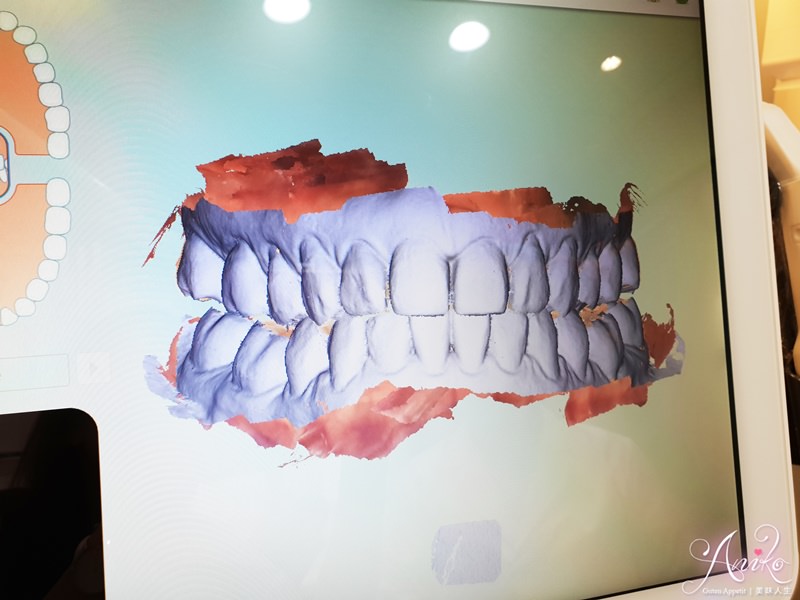 【保養】隱適美 Invisalign。終於擁有我心目中的微笑曲線！矯正成果大公開