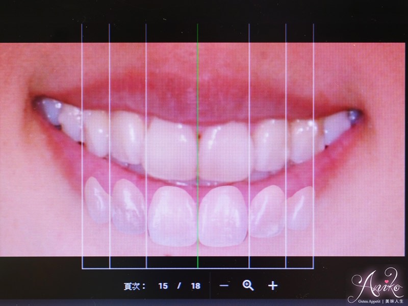 【保養】隱適美 Invisalign。終於擁有我心目中的微笑曲線！矯正成果大公開