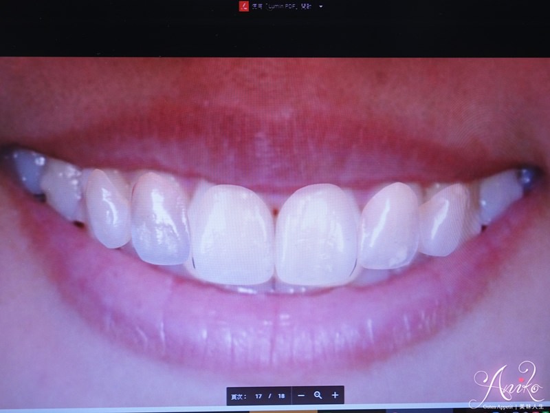 【保養】隱適美 Invisalign。終於擁有我心目中的微笑曲線！矯正成果大公開