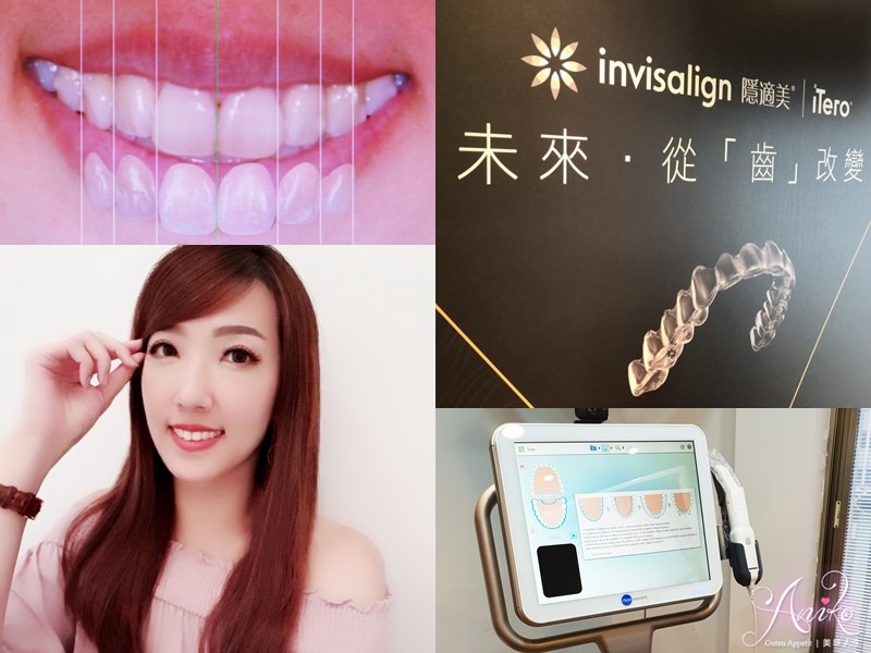 【保養】隱適美 Invisalign。終於擁有我心目中的微笑曲線！矯正成果大公開